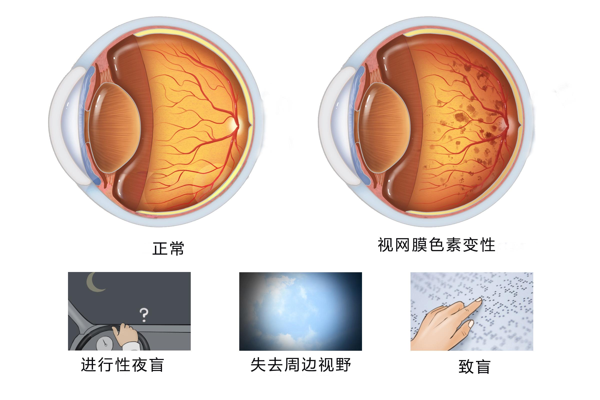 视网膜色素变性最新研究进展概述